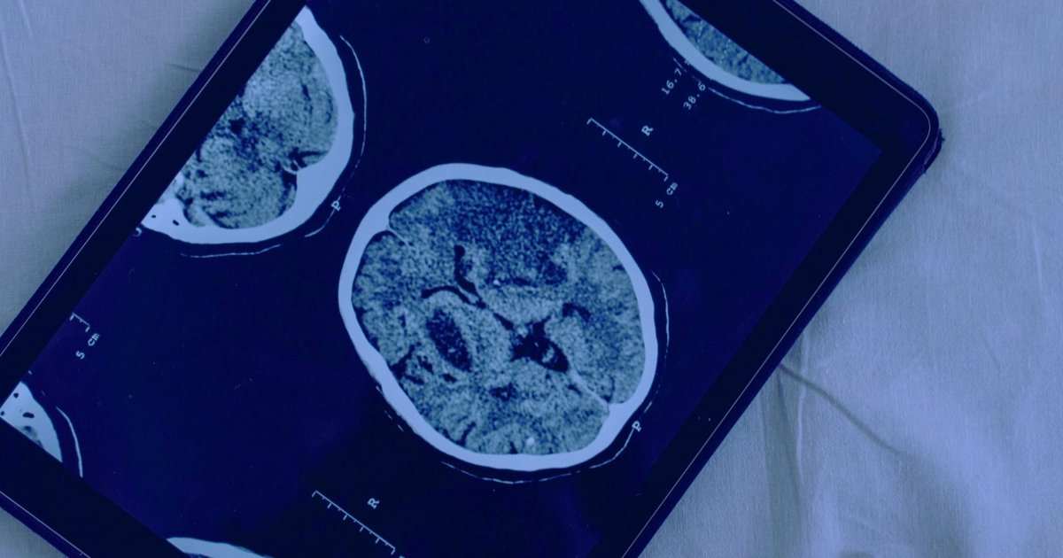 What Drives Sam Altman's Fascination with Brain Implant Technology?